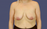 Breast Lift w/ Augmentation 10 Before